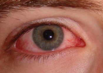 Public Health Alert: Patna Hospitals, PMCH and IGIMS Record Sharp Rise in Conjunctivitis Cases