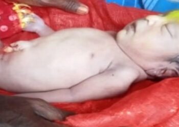 Baby Born With Tail Instead of Legs in Purnia, Doctors Left Astonished