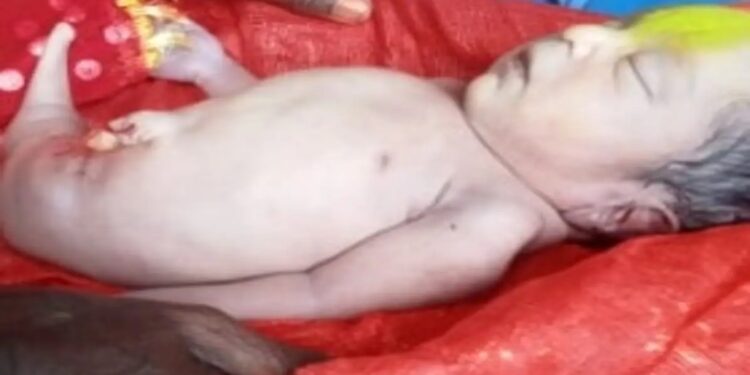 Baby Born With Tail Instead of Legs in Purnia, Doctors Left Astonished