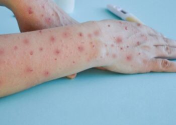 Children with red rashes and blisters receiving treatment at a hospital in Bihar during the tomato flu outbreak.