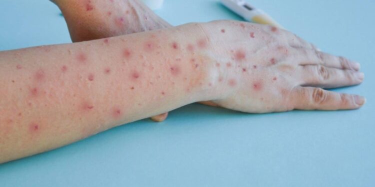 Children with red rashes and blisters receiving treatment at a hospital in Bihar during the tomato flu outbreak.