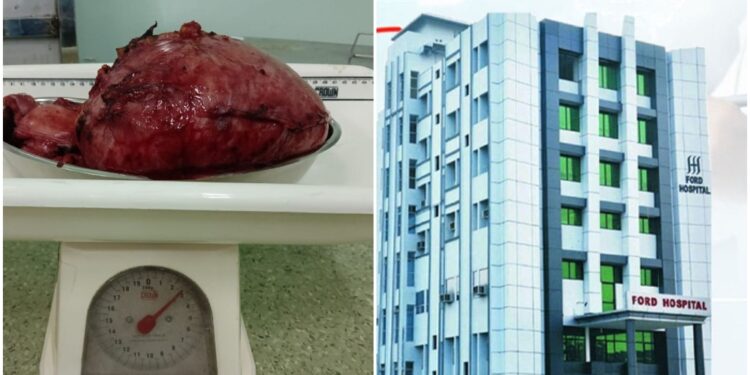 Patna Doctors Remove 3kg Tumour from Woman’s Uterus After Complex Surgery