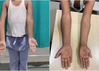 AIIMS Patna Successfully Treats Over 700 Children with Complex Orthopaedic Conditions in Five Years