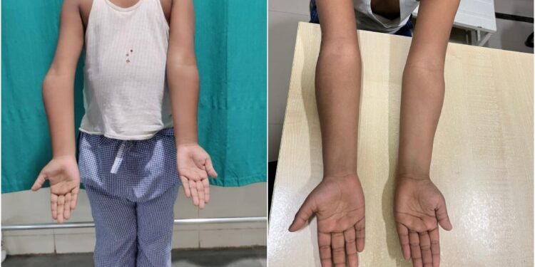 AIIMS Patna Successfully Treats Over 700 Children with Complex Orthopaedic Conditions in Five Years