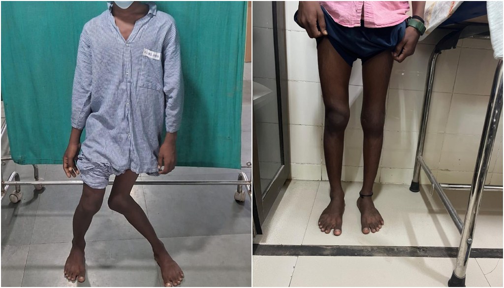 AIIMS Patna Successfully Treats Over 700 Children with Complex Orthopaedic Conditions in Five Years