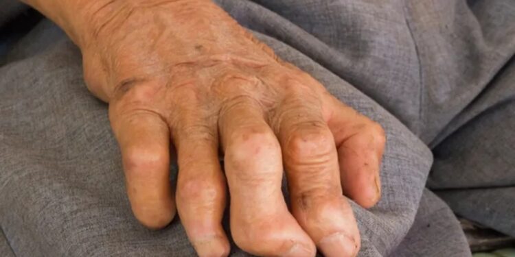As Ageing Leprosy Drugs Falter, Bihar Dermatologists Turn to New Therapies and Awareness Drives Ahead of World Leprosy Day