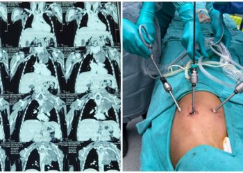 Rare chest tumour removed from three-year-old in keyhole surgery at AIIMS Patna