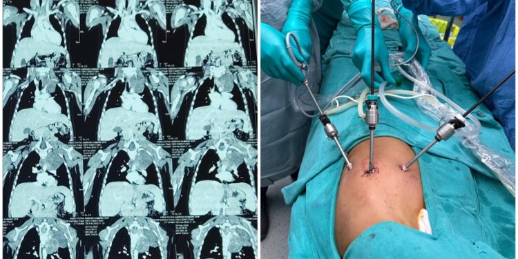 Rare chest tumour removed from three-year-old in keyhole surgery at AIIMS Patna