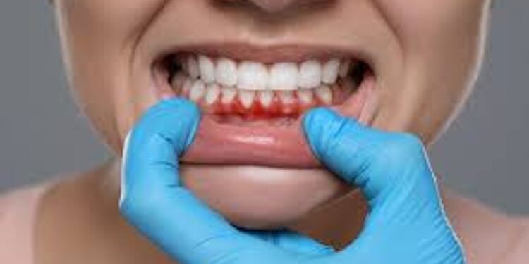 Patna Oral Health Crisis: 80% Youth Affected, Experts Warn Minor Symptoms Could Turn Deadly