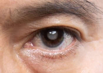 Glaucoma: The ‘Silent Thief of Sight’ That Can Gradually Steal Vision