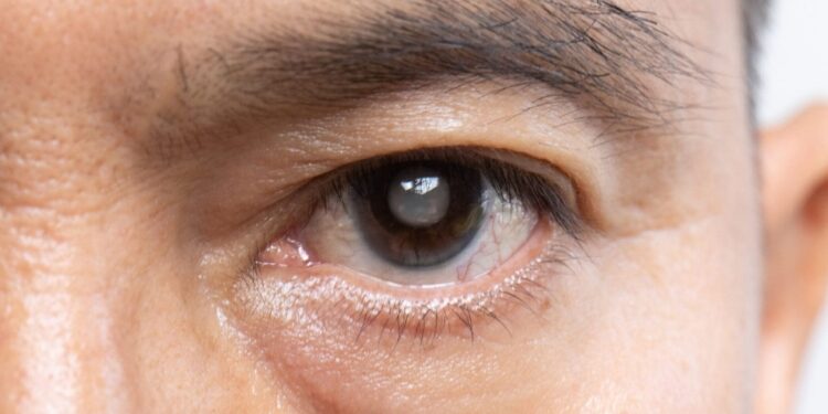 Glaucoma: The ‘Silent Thief of Sight’ That Can Gradually Steal Vision