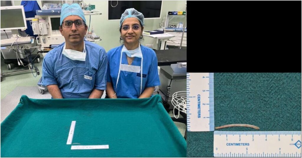 AIIMS Patna Enters Limca Book of Records After Rare Spinal Surgery Removes 35mm Fish Bone