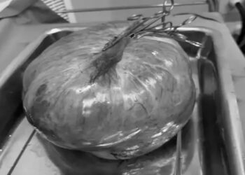 PMCH Doctors Remove 15.5kg Ovarian Tumour In Complex Surgery Amid Limited Resources