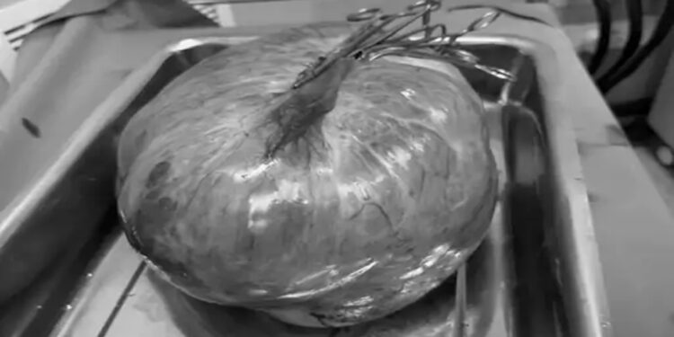 PMCH Doctors Remove 15.5kg Ovarian Tumour In Complex Surgery Amid Limited Resources