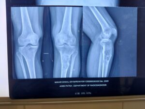 AIIMS Patna Saves 25 Year Old from Amputation in Rare Bone Cancer Case