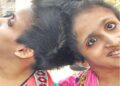 Three Months Without Medicines: Why a Supreme Court Order Has Not Reached Patna’s Conjoined Sisters