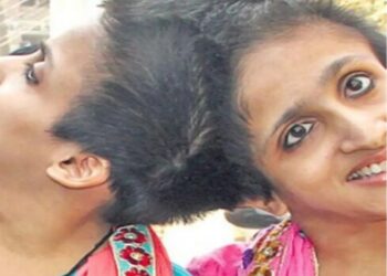 Three Months Without Medicines: Why a Supreme Court Order Has Not Reached Patna’s Conjoined Sisters