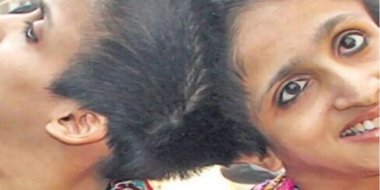 Three Months Without Medicines: Why a Supreme Court Order Has Not Reached Patna’s Conjoined Sisters