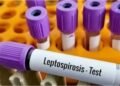 Second Leptospirosis Case Reported At NMCH In Five Days As Patna Sees Monsoon Risk Rise