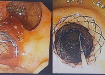 IGIMS Patna Achieves First: Two Stents Placed in Single Procedure for 82-Year-Old Cancer Patient