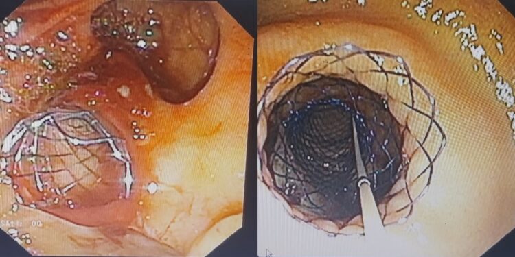 IGIMS Patna Achieves First: Two Stents Placed in Single Procedure for 82-Year-Old Cancer Patient