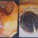 IGIMS Patna Achieves First: Two Stents Placed in Single Procedure for 82-Year-Old Cancer Patient